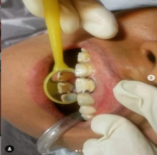 درمان پوسیدگی دندان در کودکان دکتر فرنوش پیکانپور