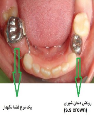 فضا نگهدار دندان در کوکان دکتر فرنوش پیکانپور