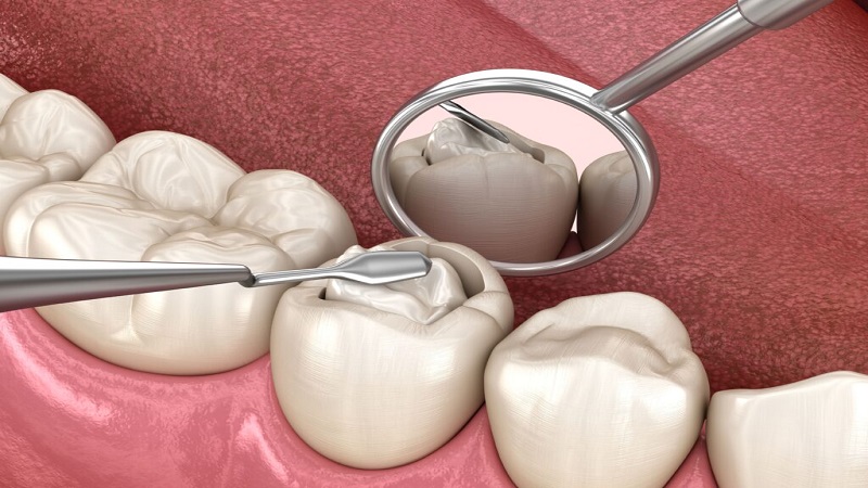 بهترین دندانپزشک کودک اصفهان |  انواع مواد پرکننده دندان