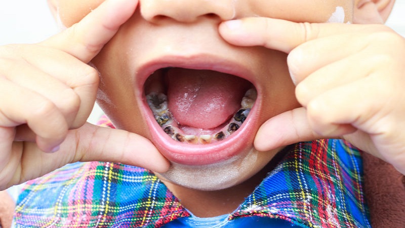 بهترین دندانپزشک کودک اصفهان |  علائم پوسیدگی دندان در کودکان