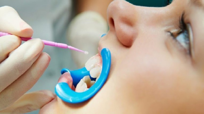 بهترین دندانپزشک کودک اصفهان | فلوراید تراپی چه اهمیتی دارد؟