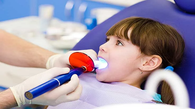 بهترین دندانپزشک کودک اصفهان | قرار دادن فیشور سیلانت در شیار دندان ها