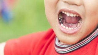 مراحل روکش کردن دندان شیری چیست؟ | بهترین دندانپزشک کودک اصفهان