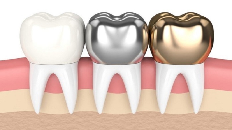انواع روکش دندان شیری | بهترین دندانپزشک کودک اصفهان