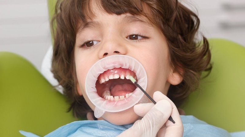 وارنیش-فلوراید-دندان-کودکان-و-بزرگسالان.jpg