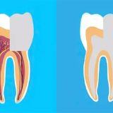 پالپوتومی و پالپکتومی چه تفاوتی با هم دارند؟ | بهترین دندانپزشک کودک اصفهان