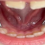 مراقبت از فضا نگهدار دندان چگونه است؟ | بهترین دندانپزشک کودک اصفهان